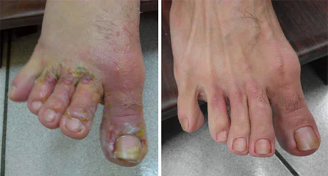 Medix™ Athlete’s Foot & Fungus Spray - Image 7
