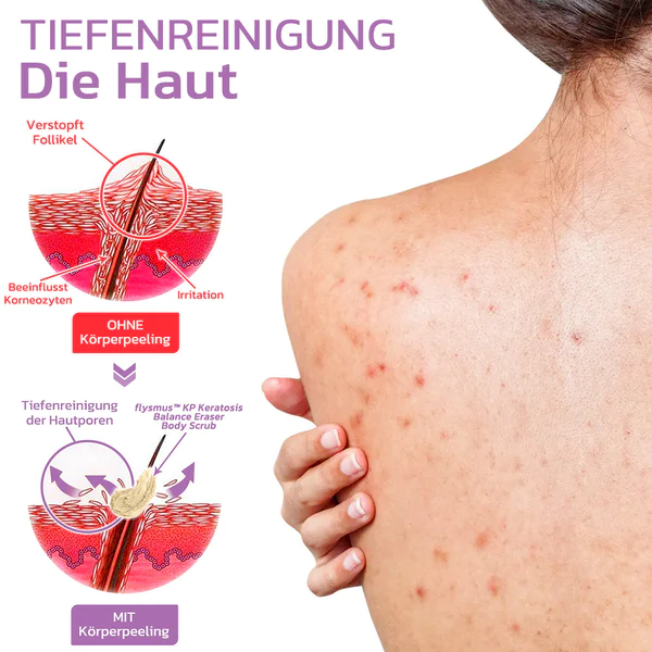 flysmus™ KP Keratose Gleichgewicht Radiergummi Körper Peeling - Image 7
