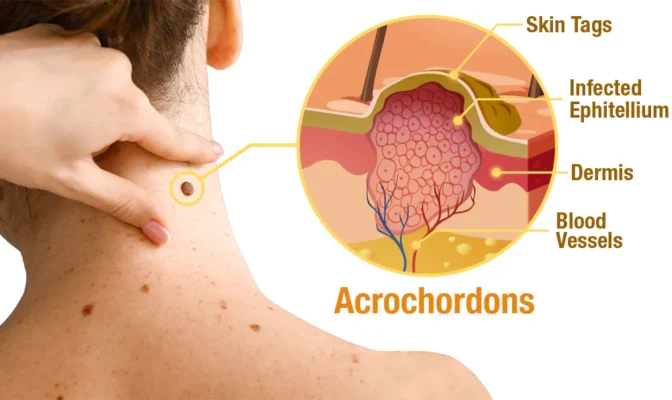 SEAGRIL™ Bee Venom Wart & Tag Removal Cream - Image 8