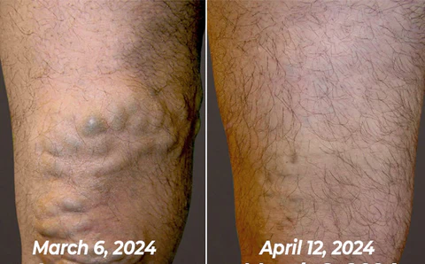 flysmus™ Varico-X Vein Dredge Bee Venom Spray - Image 13