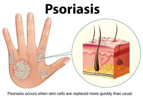 SkinMedix™ Natural Herbaceous Plants Psoriasis Cream - Image 10