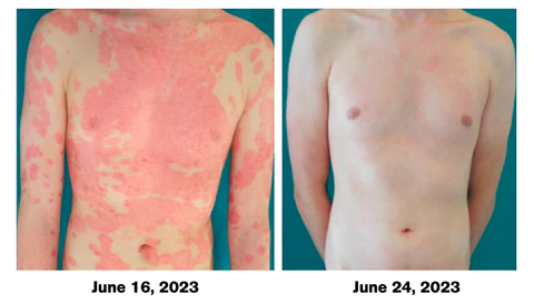 ATTDX Psoriasis Treatment BeeVenom Cream - Image 5