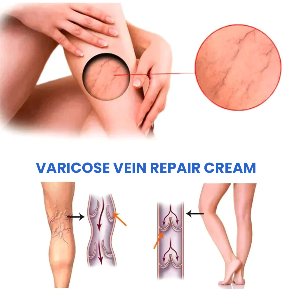 Oveallgo™ VenenErleichtern Varikosener Spray - Image 11