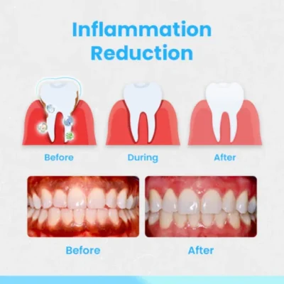 Ceoerty™ RevitaDent Gum Repair Strips - Image 3