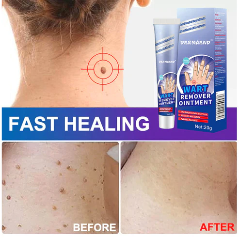 DermaEnd™ Wart Remover Herbal Ointment 100% Natural - Image 3