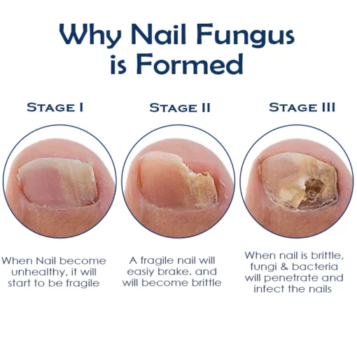 ATTDX NailRepair Fungus Treatment Pen - Image 6