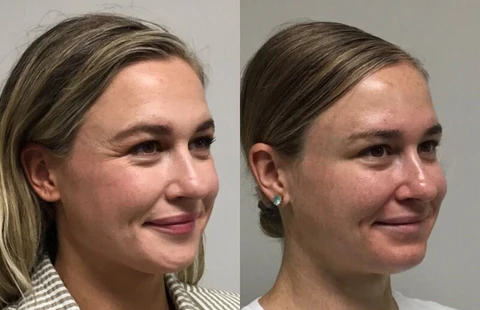 BeYouth™ Pro-Collagen Ampoule - Image 5