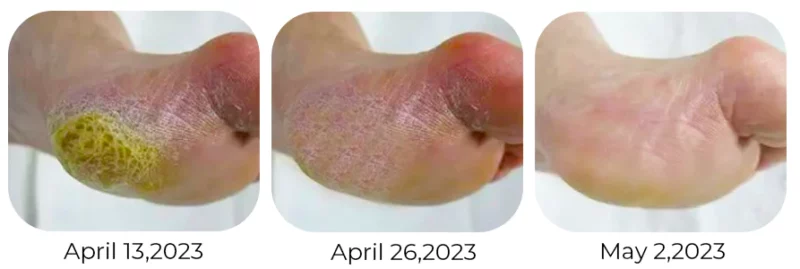 Biancat™ Callus Removing Foot Spray - Image 5