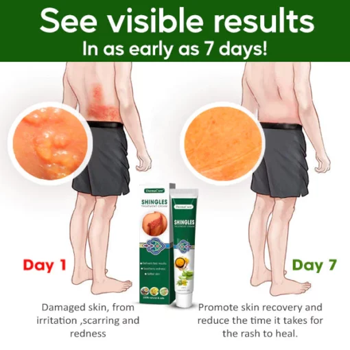 DermaCure™ Shingles Treatment Cream - Image 4