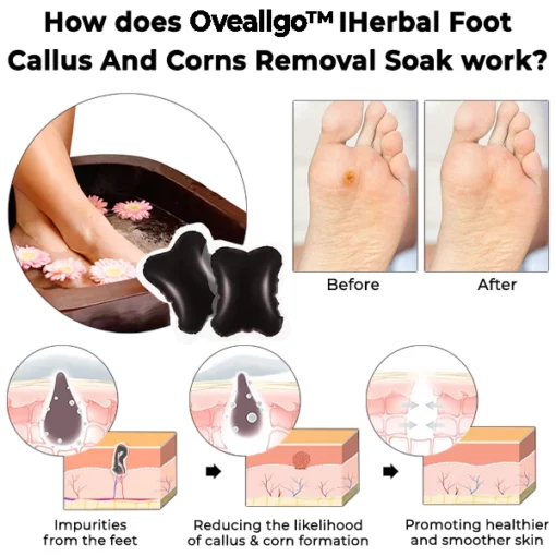 Oveallgo™ IHerbal Foot Callus And Corns Removal Soak - Image 3
