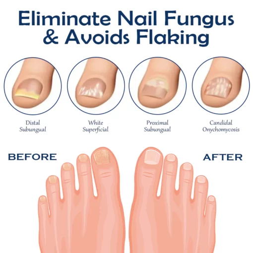 ATTDX NailRepair Fungus Treatment Pen - Image 4