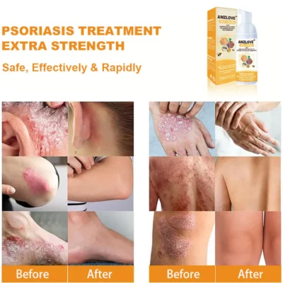 Awzlove™ Bee Venom Psoriasis Treatment Mousse - Image 4