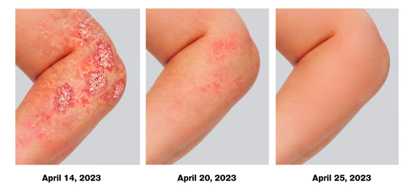ATTDX Psoriasis Treatment BeeVenom Cream - Image 4
