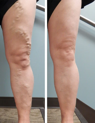 VeinFix Varicose Healing Spray - Image 4