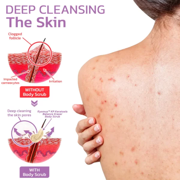 flysmus™ KP Keratosis Balance Eraser Body Scrub - Image 6