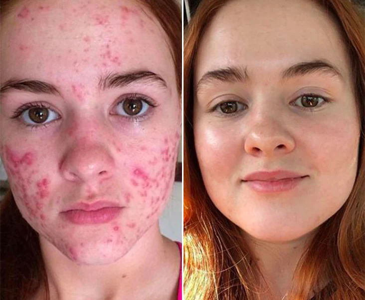 Fivfivgo™ ClariSkin 2% Salicylsäure Ausgleichendes Reparaturserum - Image 7