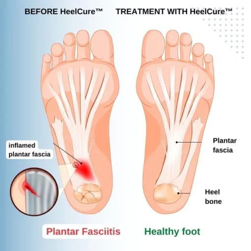 HeelCure™ Plantar Fasciitis Pain Relief Cream - Image 4