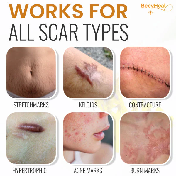 BeevHeal™ Scar Removal Spray - Image 7