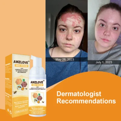 Awzlove™ Bee Venom Psoriasis Treatment Mousse - Image 5