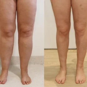 Ceoerty™ LymphaCare Bee Venom Soaking Beads - Image 9