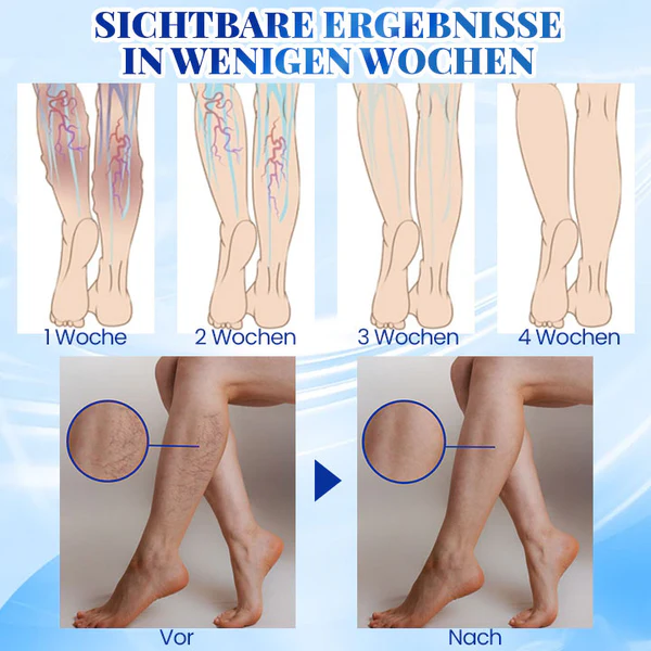 Biancat™ Blaulicht-Therapie-Set für Krampfadern - Image 5