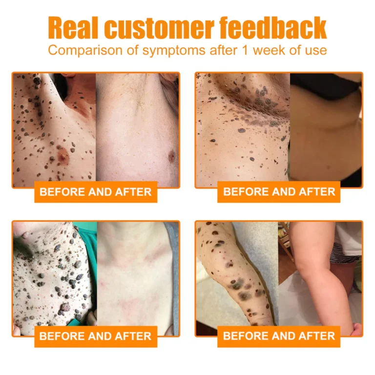 ZVLZVL™ Bee Venom Mole and Wart Treatment Spray - Image 11