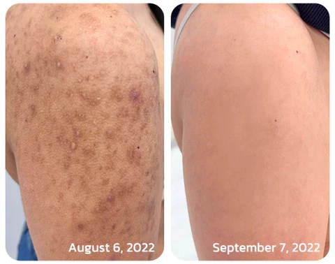 flysmus™ KP Keratosis Balance Eraser Body Scrub - Image 4