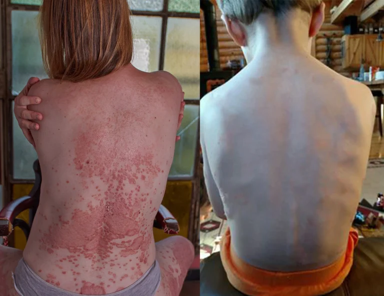 SEAGRIL™ Bee Venom Wart & Tag Removal Cream - Image 5