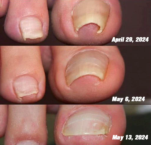 Furzero™ Nagelverteidigung Bienengift-Behandlungsserum pro - Image 10