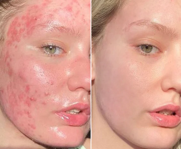 Fivfivgo™ ClariSkin 2% Salicylsäure Ausgleichendes Reparaturserum - Image 6