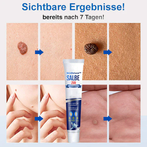 SkinDeluxe™ Salbe zur Warzenentfernung - Image 6