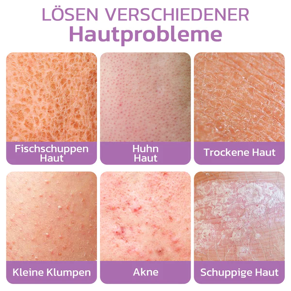 flysmus™ KP Keratose Gleichgewicht Radiergummi Körper Peeling - Image 3