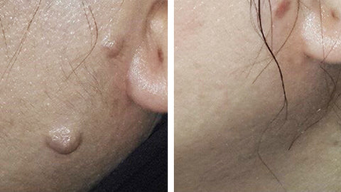 SkinDeluxe™ Salbe zur Warzenentfernung - Image 5