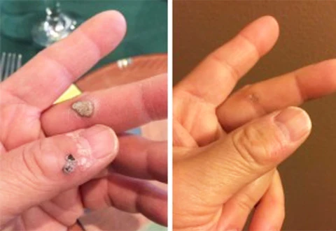 SkinDeluxe™ Salbe zur Warzenentfernung - Image 3