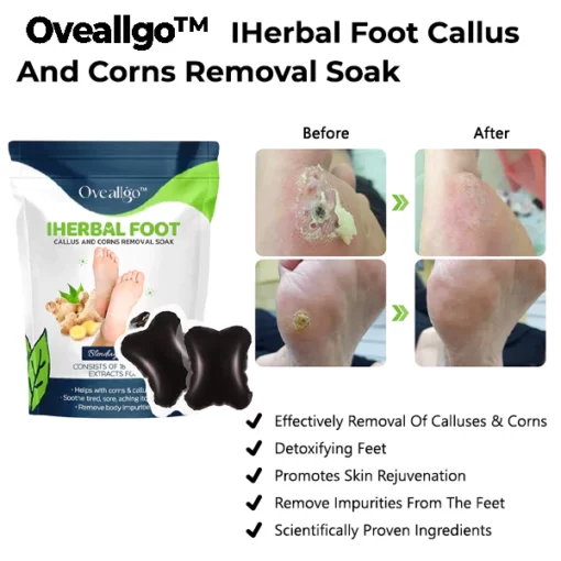 Oveallgo™ IHerbal Foot Callus And Corns Removal Soak - Image 5
