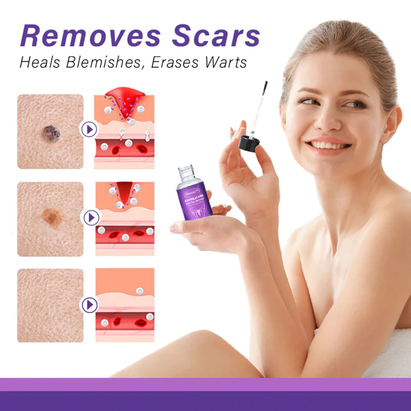 Seurico™AraneaCare Skin Tag Remover - Image 4