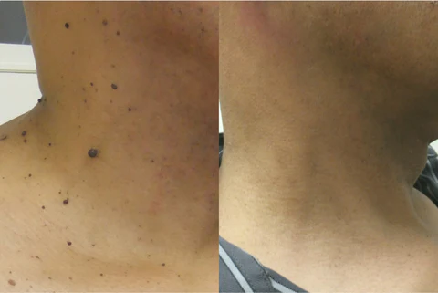 LOVILDS™ Tags & Moles Remover - Image 6