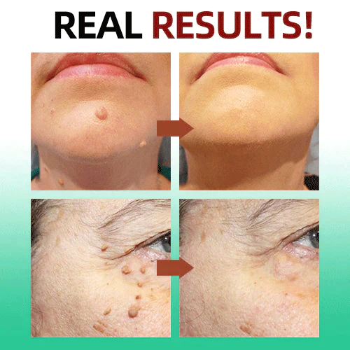 Biancat™Tags & Moles Remover - Image 4