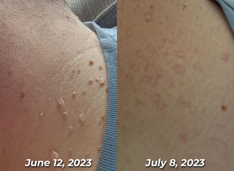 Seurico™ Bee Venom Power Mole & Wart Remover Spray - Image 5