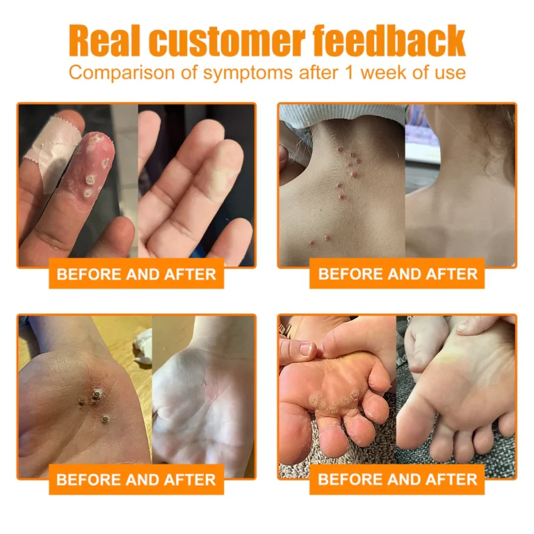 ZVLZVL™ Bee Venom Mole and Wart Treatment Spray - Image 6