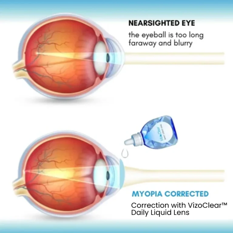 VizoClear™ Daily Liquid Lens - Image 8