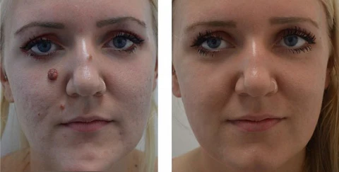 LOVILDS™ Tags & Moles Remover - Image 4