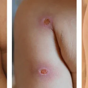 FLYCARE™ Diabetic Wounds Treatment Cream - Image 4