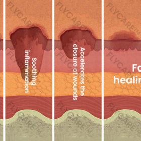 FLYCARE™ Diabetic Wounds Treatment Cream - Image 3