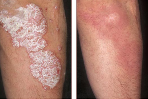 SkinMedix™ Natural Herbaceous Plants Psoriasis Cream - Image 4