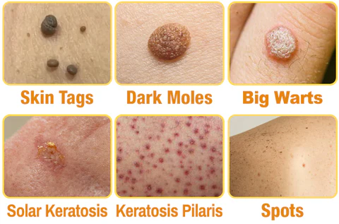 SEAGRIL™ Bee Venom Wart & Tag Removal Cream - Image 4