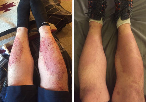 SkinMedix™ Natural Herbaceous Plants Psoriasis Cream - Image 3