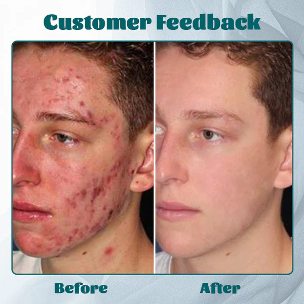 Ceoerty™ Men’s AcneFree Hydra Cream - Image 6