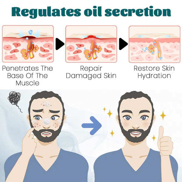 Ceoerty™ Men’s AcneFree Hydra Cream - Image 7