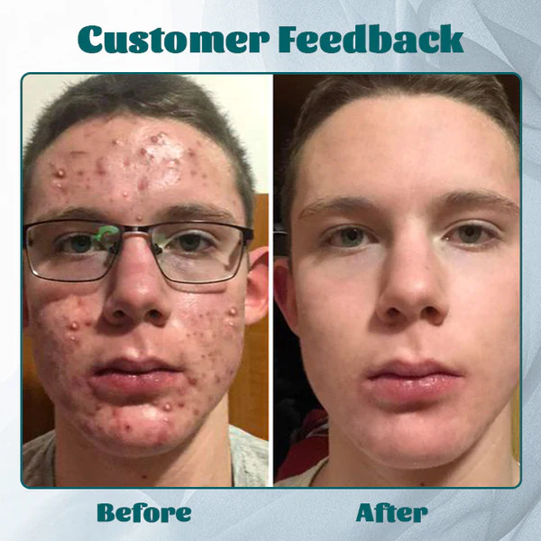 Ceoerty™ Men’s AcneFree Hydra Cream - Image 5